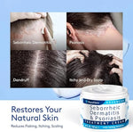 CREMA PARA CUERO CABELLUDO CON DERMATITIS SEBORREICA ROYCEDERM